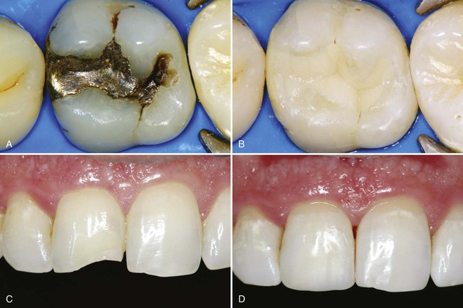 thumbnail image 2 of Dental Cavity Restoration Teeth Model - Decayed Tooth For Composite Resin Practice 2 of 6