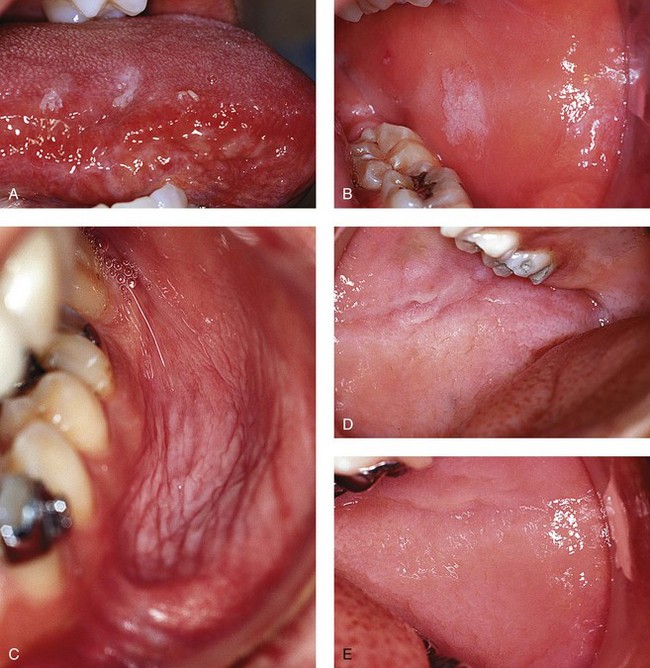 Differential Diagnosis Of Oral Lesions 23