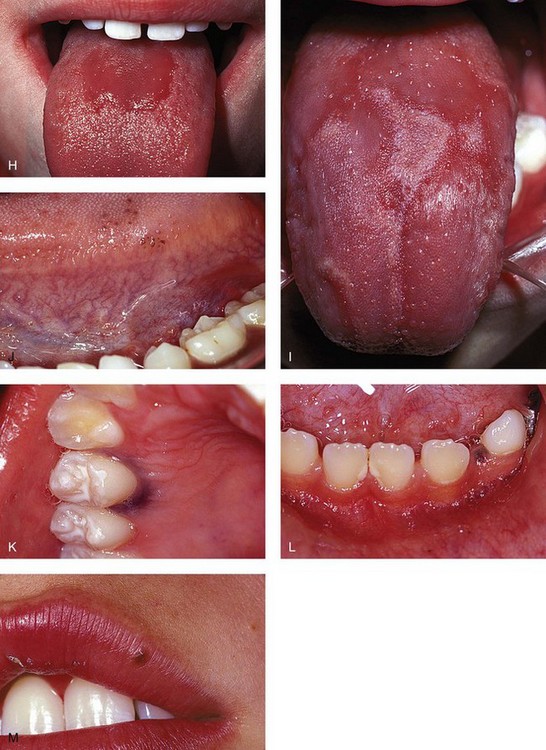 Differential Diagnosis Of Oral Lesions 40
