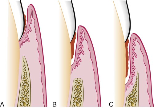 20 The Periodontal Pocket Pocket Dentistry