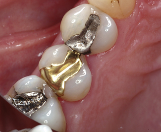 Amalgam Restorations And The Gold Standard For