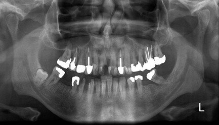 Benefits Of Panoramic Dental Radiography