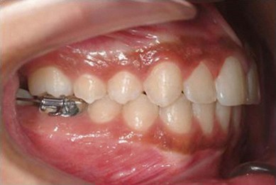 molar second extractions fig pocketdentistry