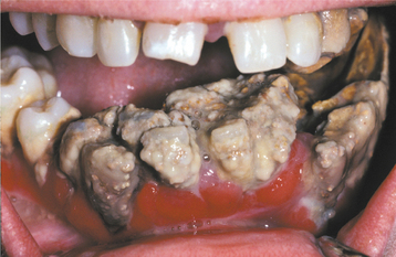 Managing Patients With Necrotizing Ulcerative Periodontitis
