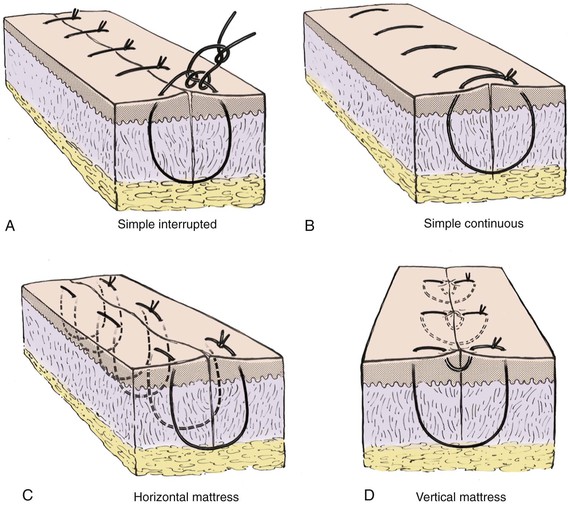 Suturing Technique | Surgical Suture