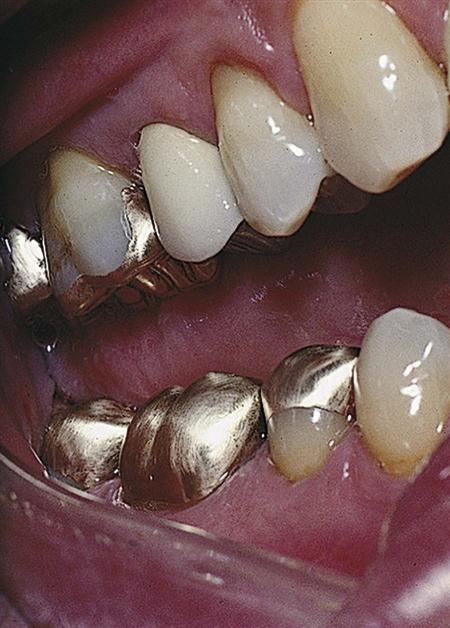 10. Casting Metals, Solders, and Wrought Metal Alloys | Pocket Dentistry