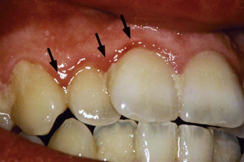 plaque periodontal disease gingival dental supragingival inflammation pocket symptoms clinical pocketdentistry