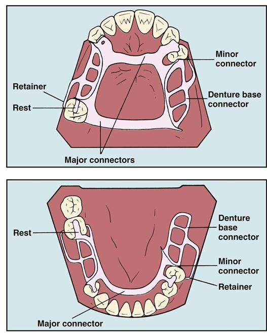 Parts Of Removable Partial Denture Design Talk