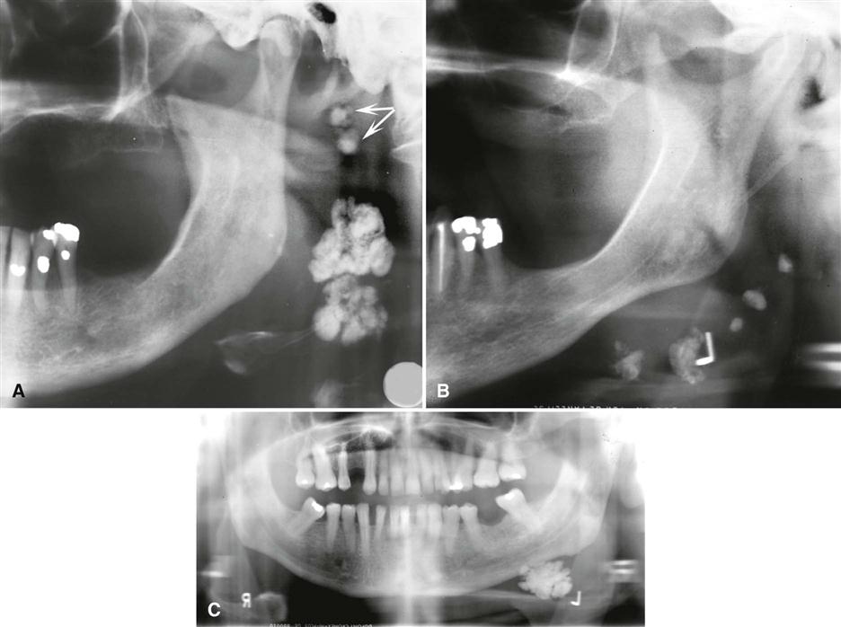 28. Soft Tissue Calcifications and Ossifications | Pocket Dentistry