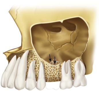 22 Maxillary Posterior Edentulism | Pocket Dentistry