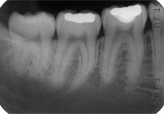 Intraoral Radiographic Principles And Techniques Pocket Dentistry