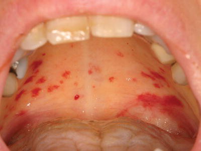 Mouth sores, Red spots and Swollen lips: Common Related ...