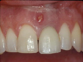 4 Infected Sites | Pocket Dentistry