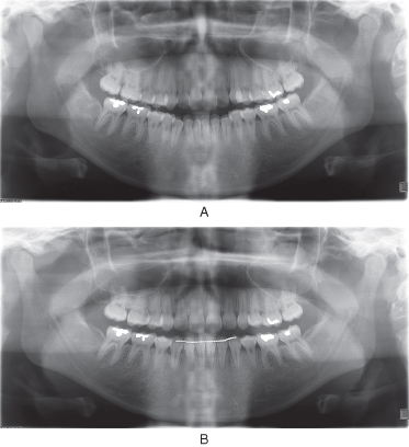 Root resorption in orthodontics literature review