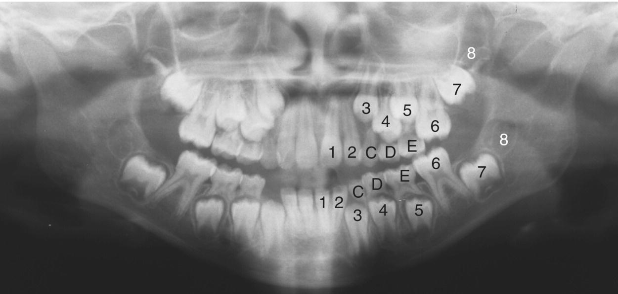 baby-teeth-vs-permanent-teeth-the-difference-sedaros-oral-surgery