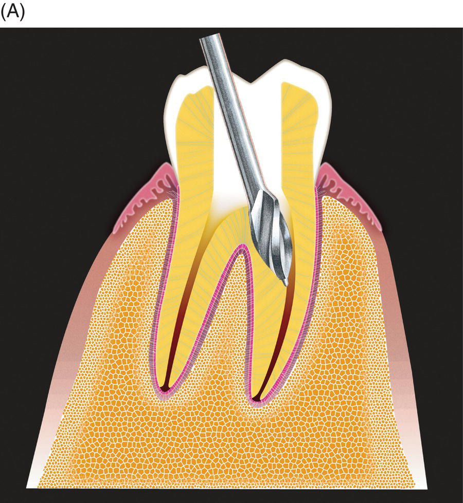 7 Use of MTA as Root Perforation Repair | Pocket Dentistry