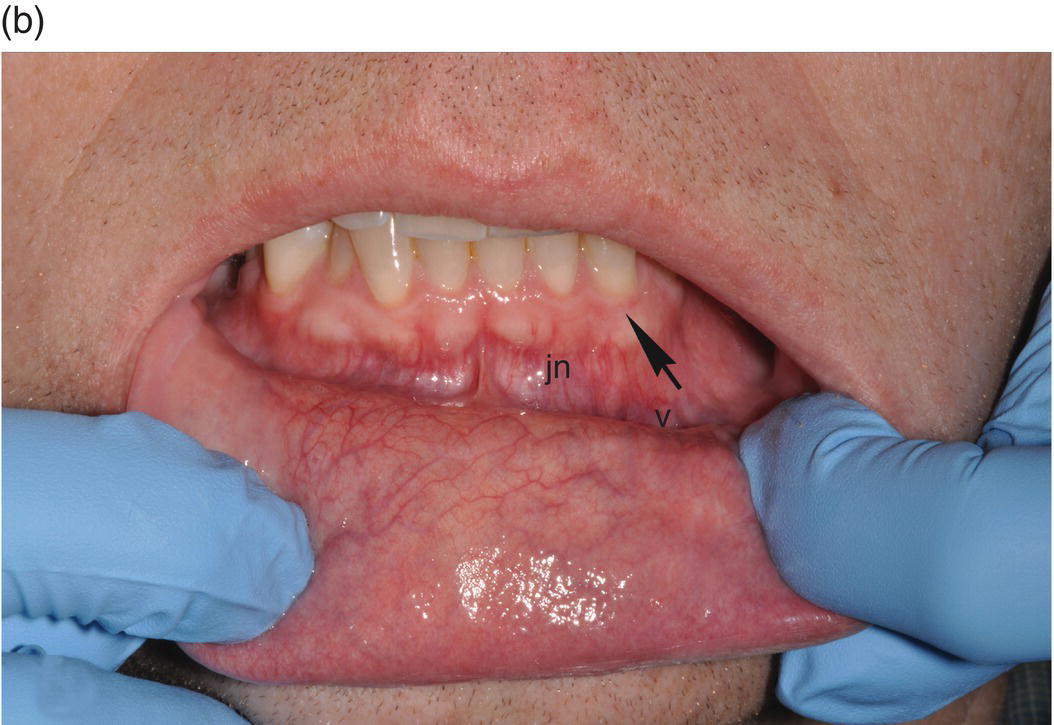 9 Oral Mucosa And Mucosal Sensation Pocket Dentistry