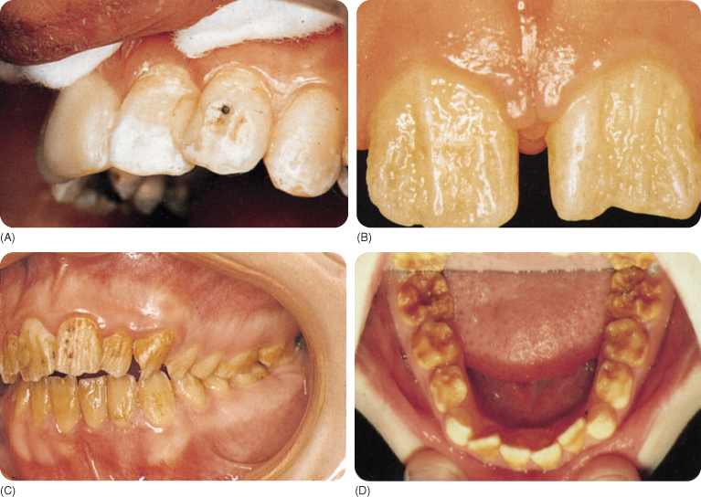 10 Discoloration of Teeth | Pocket Dentistry