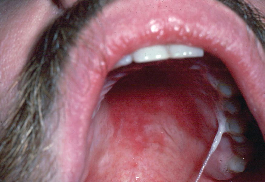 Oral Thrush Symptoms, Causes, and Treatment - WebMD