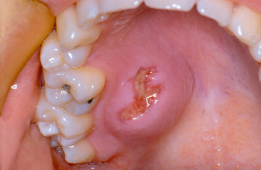 16 Surgical Treatment of Salivary Gland Disease | Pocket Dentistry
