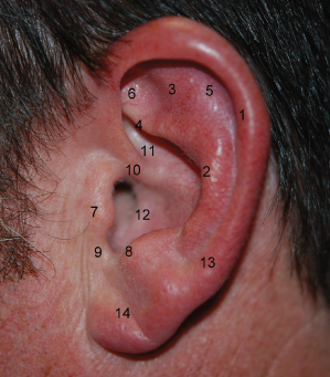 16 Otoplasty: Surgical Correction of the Prominent Ear | Pocket Dentistry