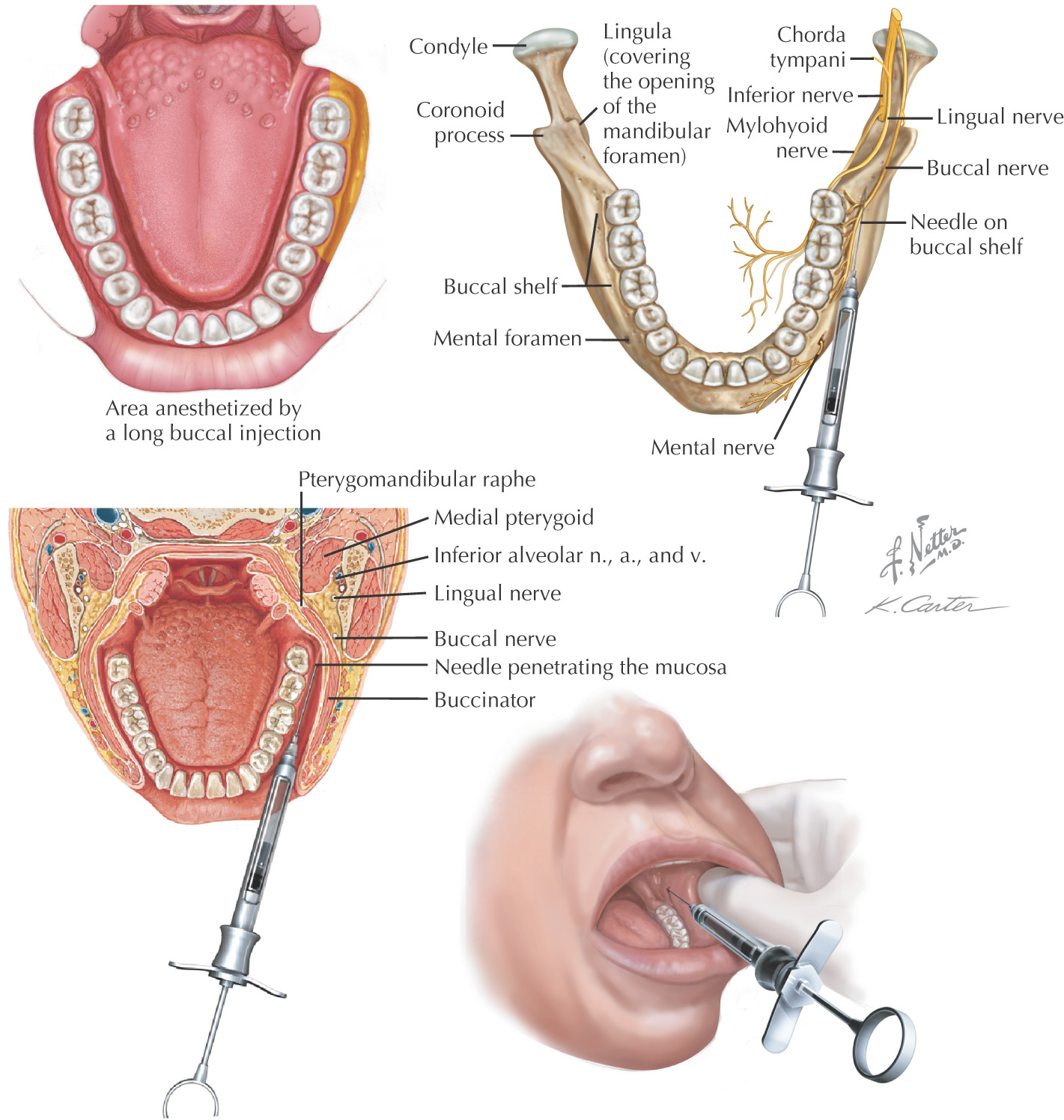 21 Intraoral Injections Pocket Dentistry