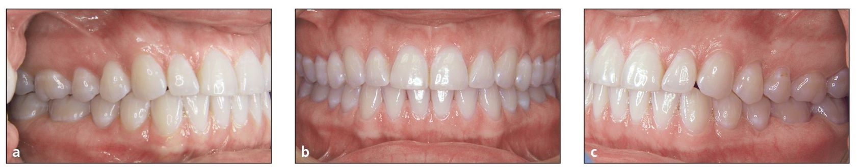 7 Functional Occlusion And Stability Pocket Dentistry