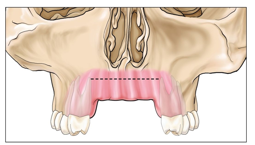 8 – Internal Alveolar Split Bone Graft | Pocket Dentistry