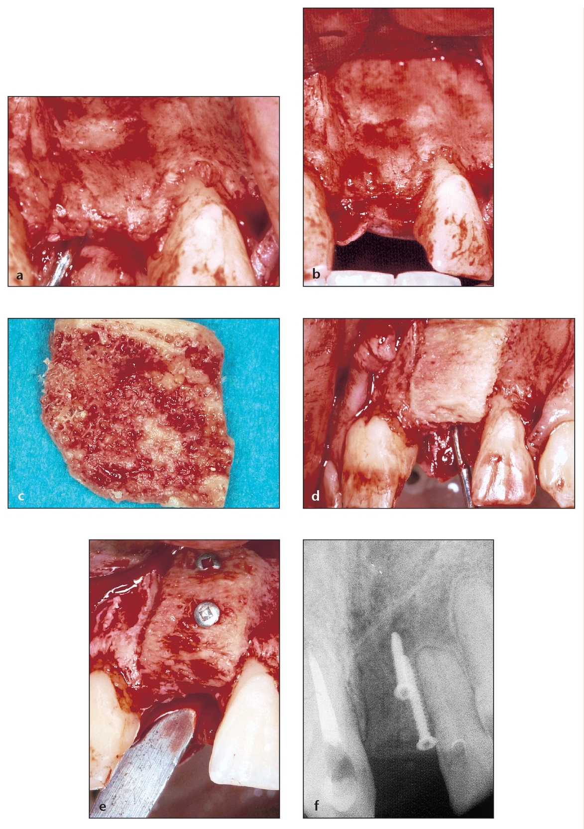 9 – Augmentation and Grafting for the Maxillary Anterior Alveolar