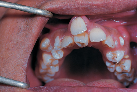 2. Disorders of development of the teeth and related tissues | Pocket