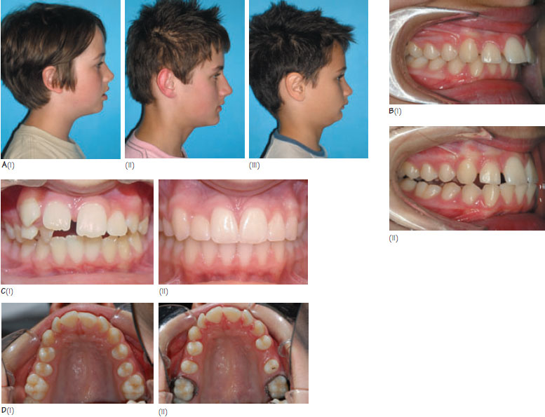 What Is Class 2 Malocclusion