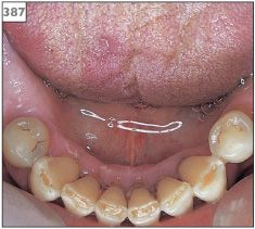 What are some causes of excessive saliva flow?