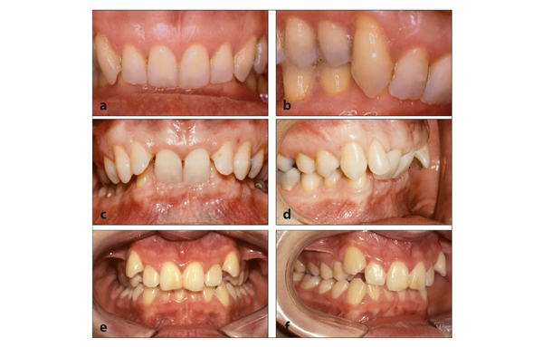 12 Class II Division 2 Malocclusions Pocket Dentistry