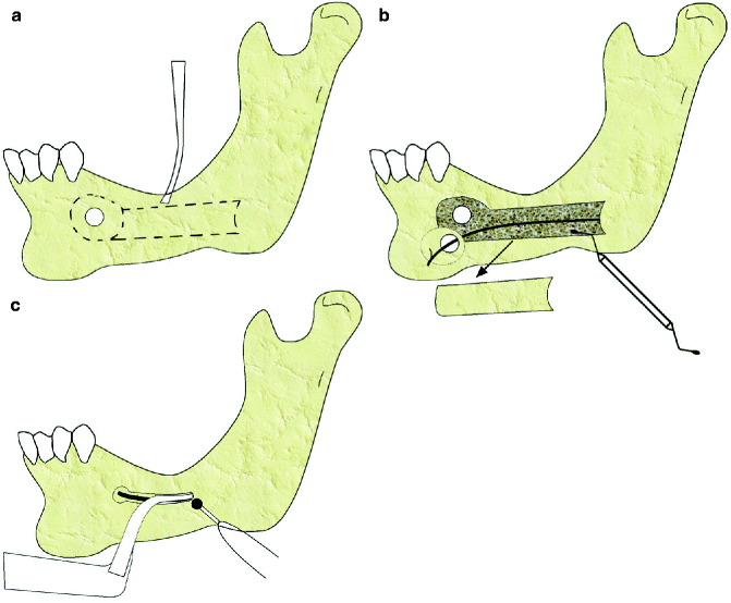 1 -Anatomia do 1º molar inferior (36). A -Face vestibular; B -Face
