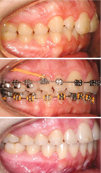 settling elastics in orthodontics