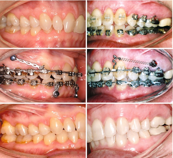 settling elastics in orthodontics