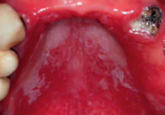 Pseudomembranous Candidiasis On Tongue