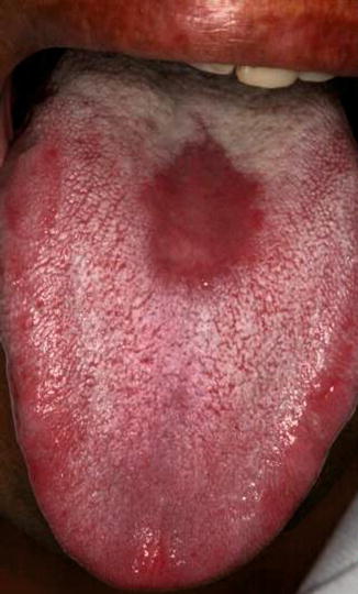 smooth red patch in mouth