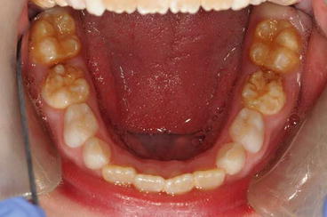 enamel hypoplasia