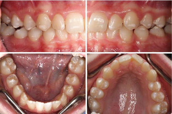 Syndromes And Diseases Associated With Developmental Defects Of Enamel Pocket Dentistry