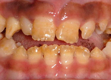 enamel hypoplasia