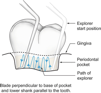 Instrumentation For Diagnosis And Basic Treatment Of Gingivitis Periodontitis Pocket Dentistry