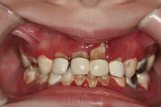 Conditions Associated with Premature Exfoliation of Primary Teeth or ...