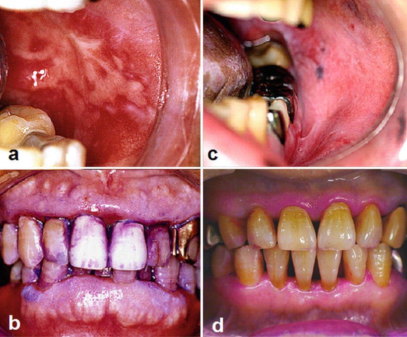 Cancer Patient Dental Care Surgery