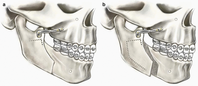 A318559_1_En_9_Fig5_HTML.gif