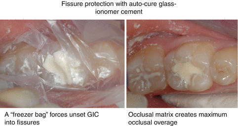 Glass-Ionomer Cements 