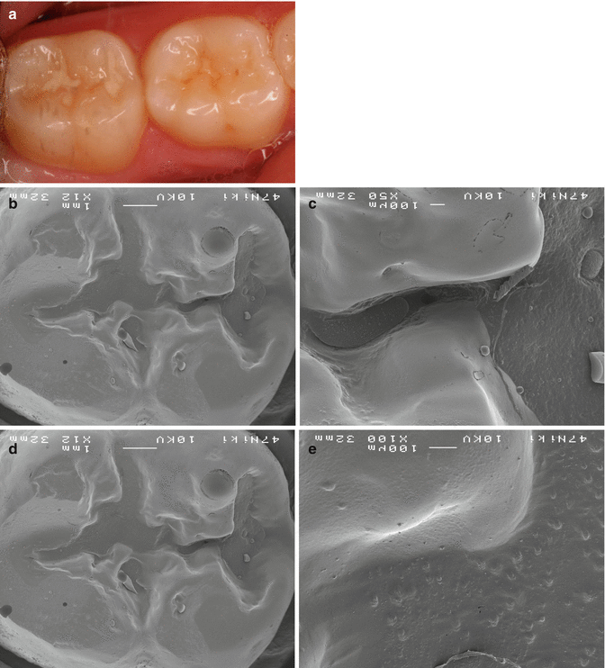 glass ionomers in dentistry