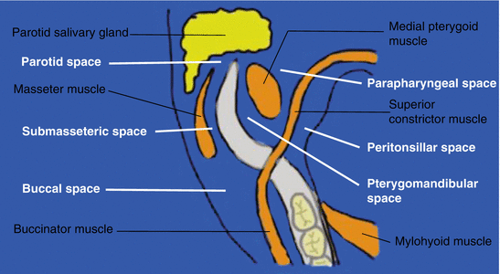 pterygomandibular space abscess