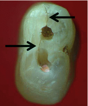 Categorization of Dental Fractures