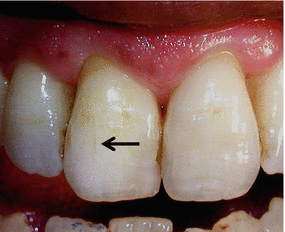 Tooth Cracks & Craze Lines: Here What You Should Know » Top
